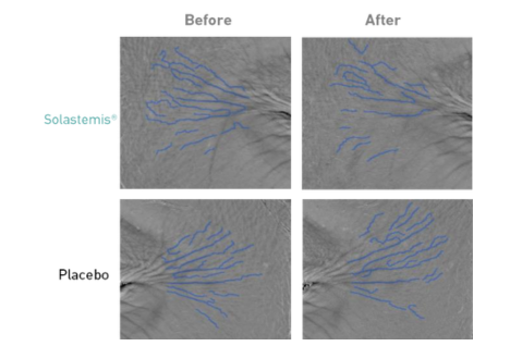 Before / after Solastemis